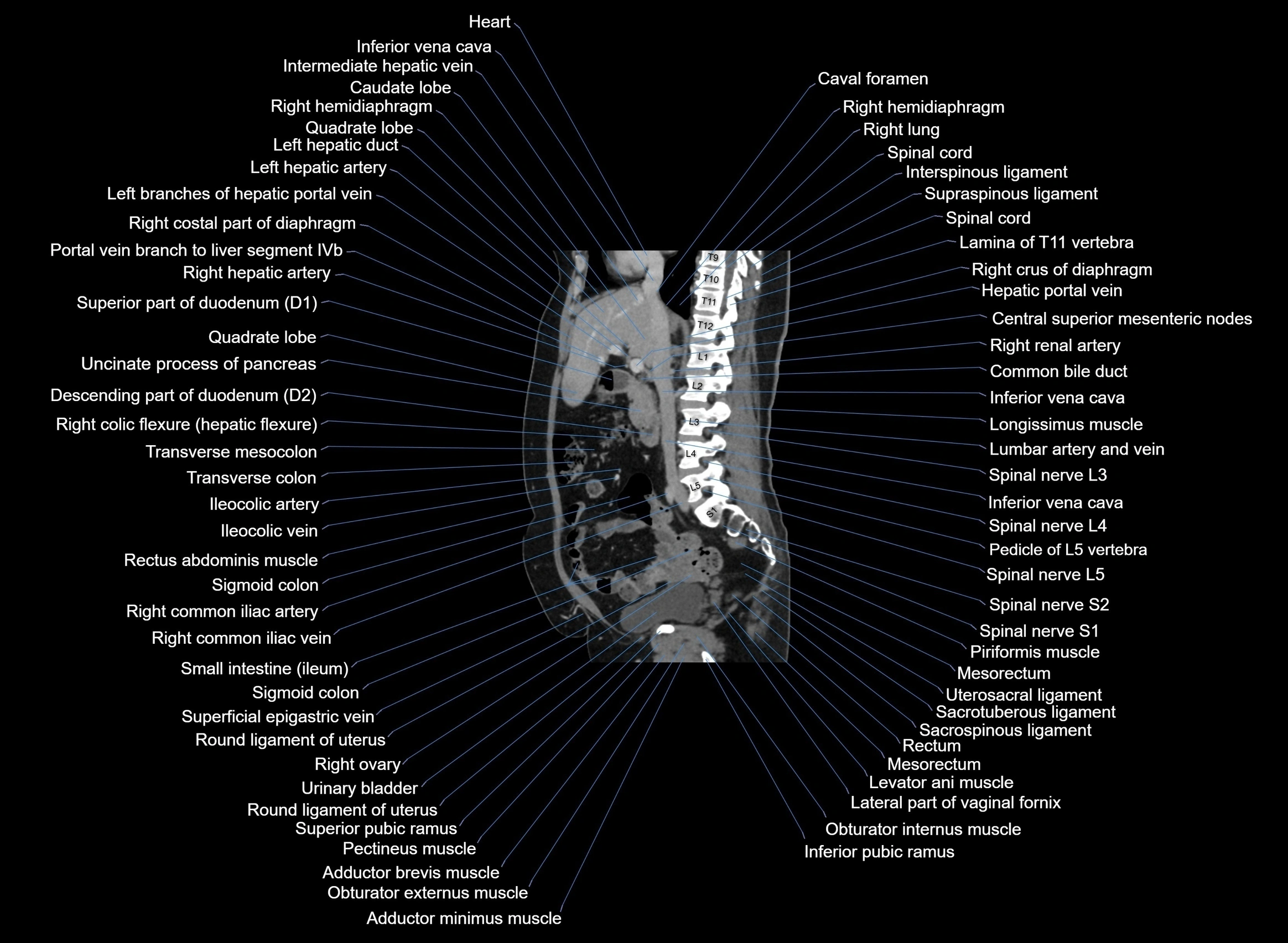 CT Abdomen sagittal cross sectional anatomy labelled radiology image -00067.webp